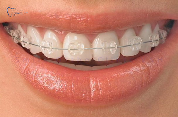 NIỀNG MẮC CÀI SỨ